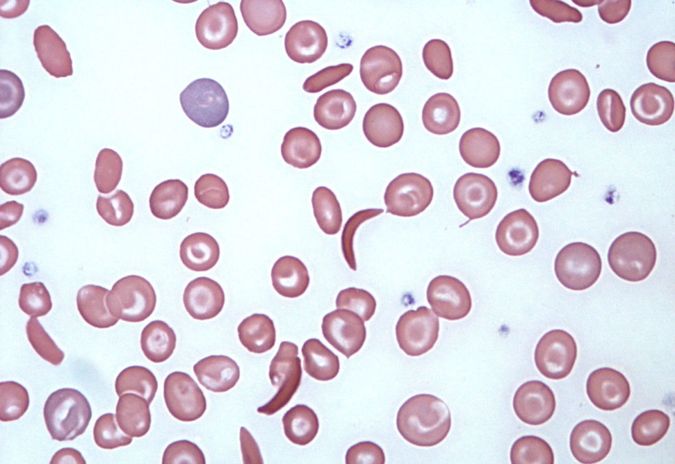 Image of Sickle Cells
